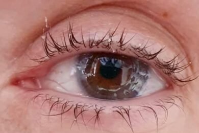 Urgent need for cornea donors to help restore sight of transplant patients