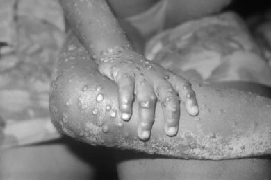 Monkeypox cases confirmed in England, plus FAQs